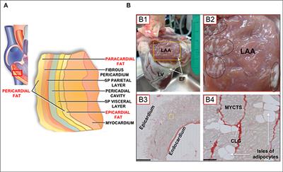 Fatty Infiltration of the Myocardium and Arrhythmogenesis: Potential Cellular and Molecular Mechanisms